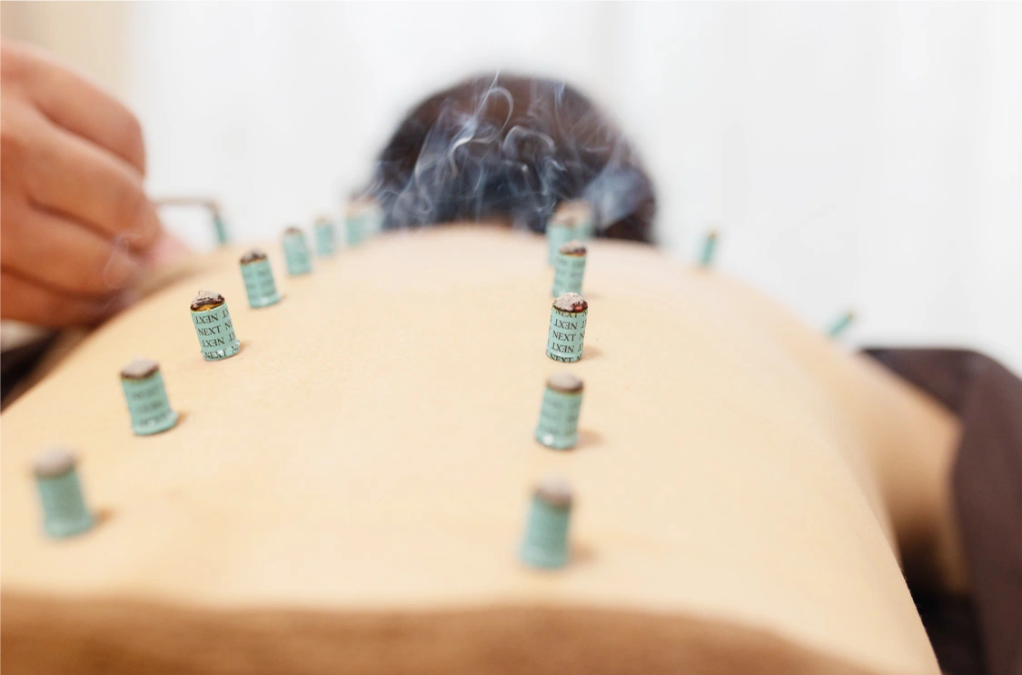 美容鍼｜名古屋市昭和区