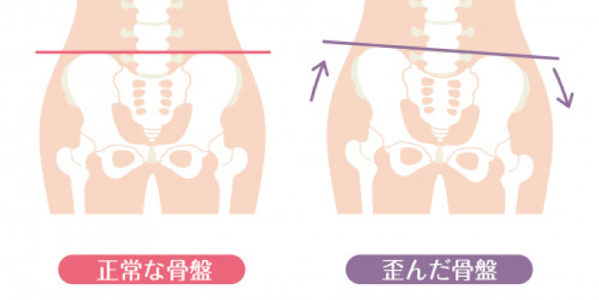 骨盤を整えることで｜名古屋